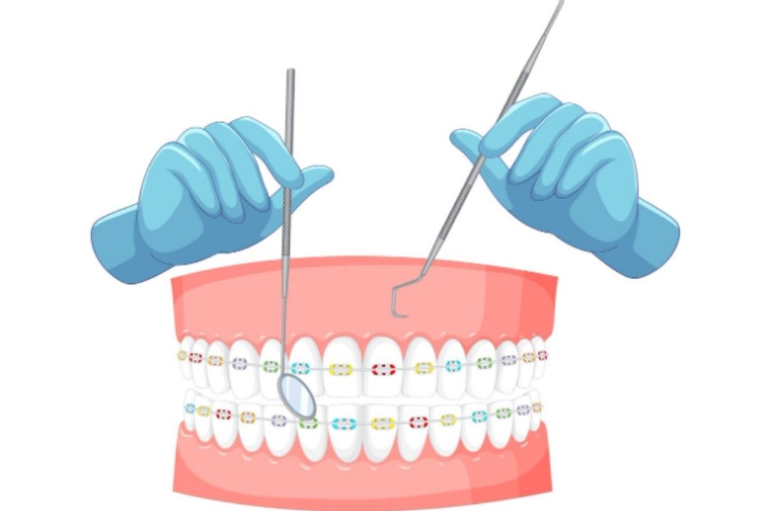 teeth braces price in mumbai